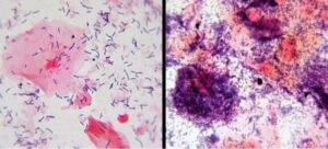 Vaginal Microbiome Changes During Pregnancy