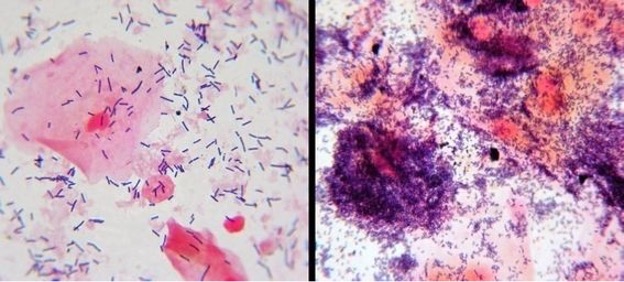 Vaginal Microbiome Changes During Pregnancy