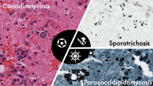 Histopathologic Analysis of Fungi — PathElective