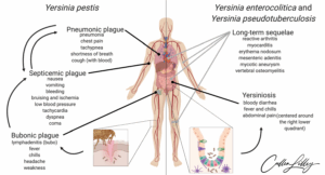 Symptomatology of Pathogenic Yersiniae — PathElective