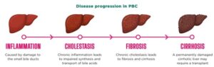 Insights into Diagnosis, Symptoms, and Treatment...