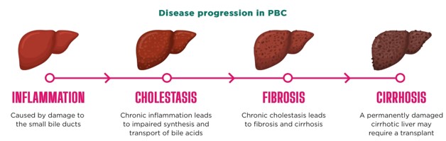 Insights into Diagnosis, Symptoms, and Treatment...
